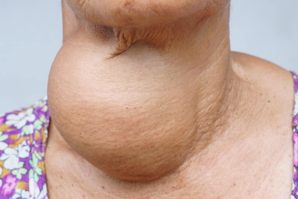 Signs and Symptoms of Thyroid Nodules