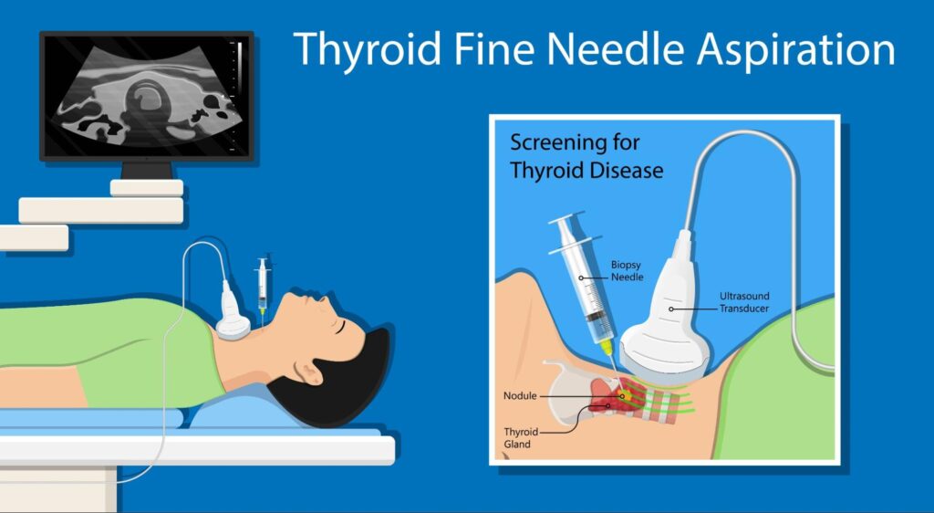 Thyroid Fine Needle Aspiration