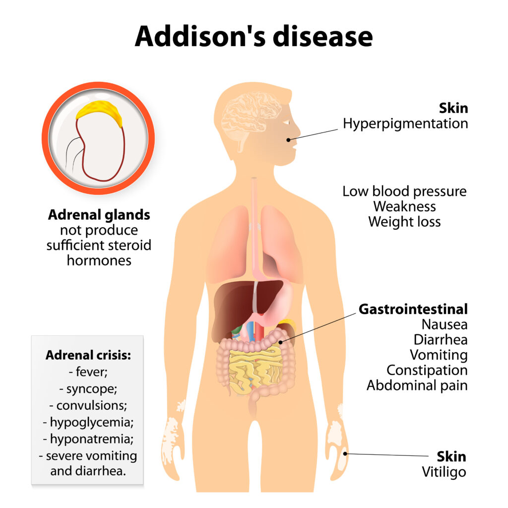 Adrenal Insufficiency Symptoms Causes Treatment Guide Adrenal Insufficiency Symptoms Causes Treatment Guide