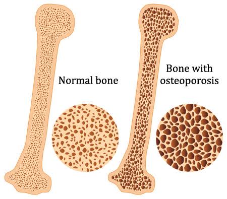Metabolic Bone Disease Osteoporosis