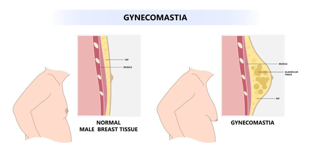 Chipstuttar Enlargement of Breasts in Males (Gynecomastia)
