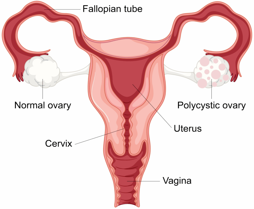What is Polycystic Ovary Syndrome (PCOS)