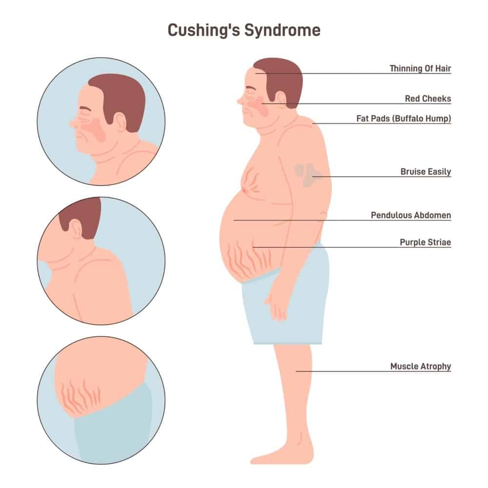 Cushing’s syndrome