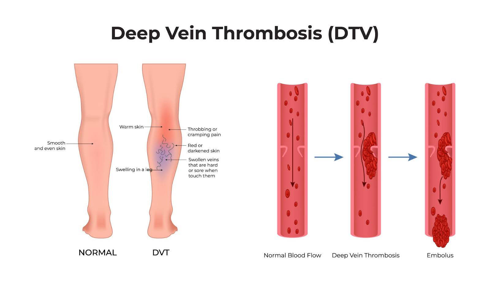 Deep Vein Thrombosis (DTV)